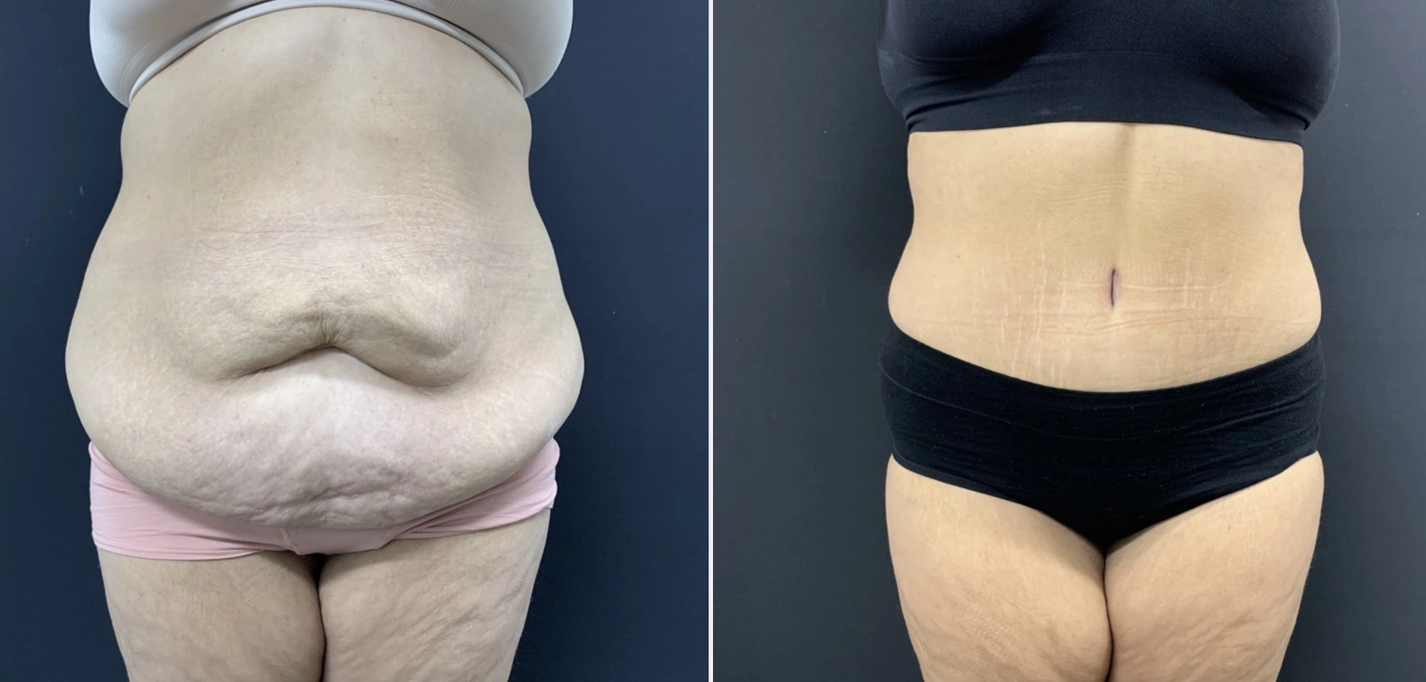 TUMMY TUCK Before & After Case Number 00062