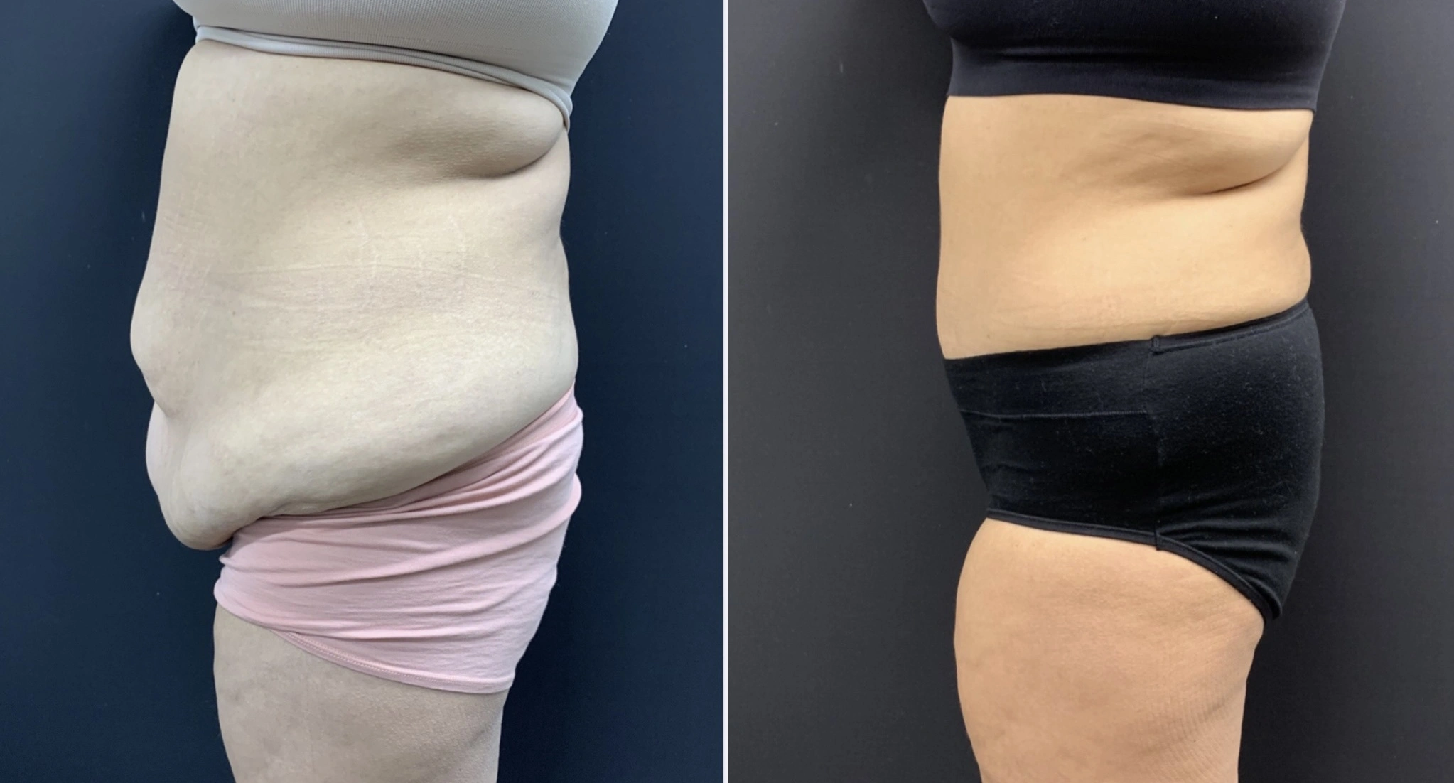 TUMMY TUCK Before & After Case Number 00062