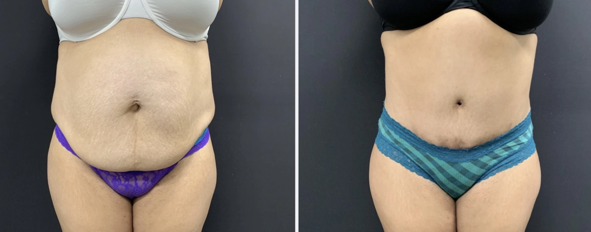 TUMMY TUCK Before & After Case Number 00064