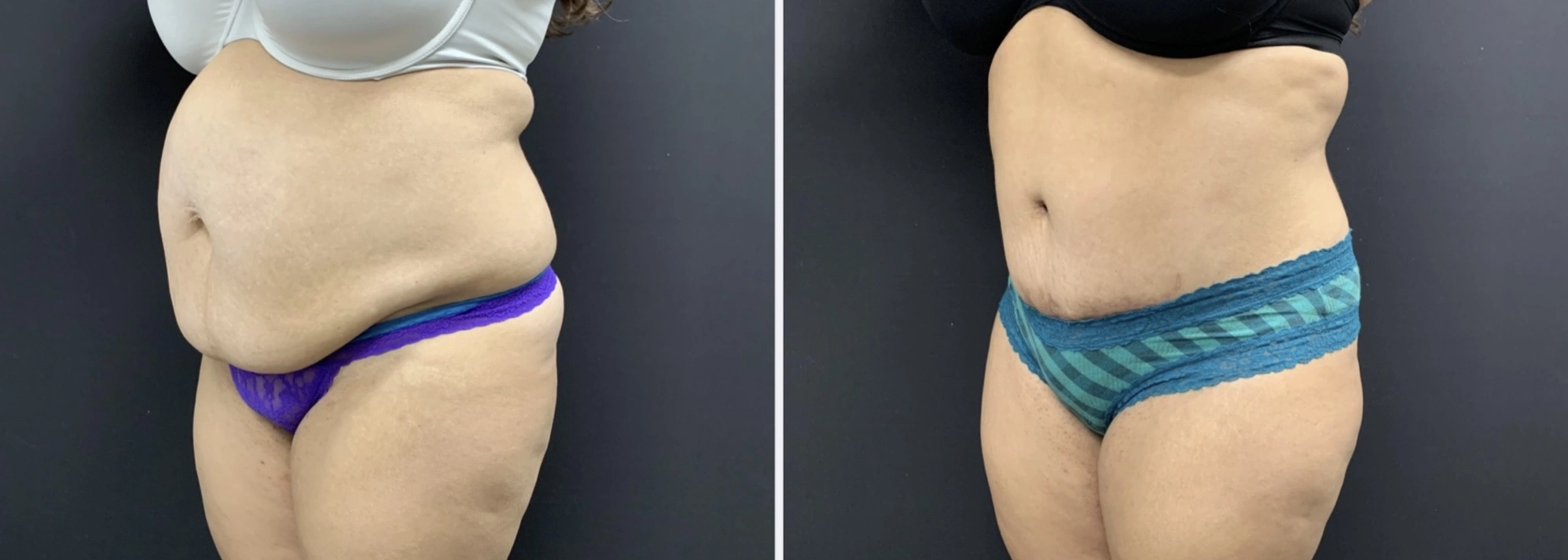 TUMMY TUCK Before & After Case Number 00064