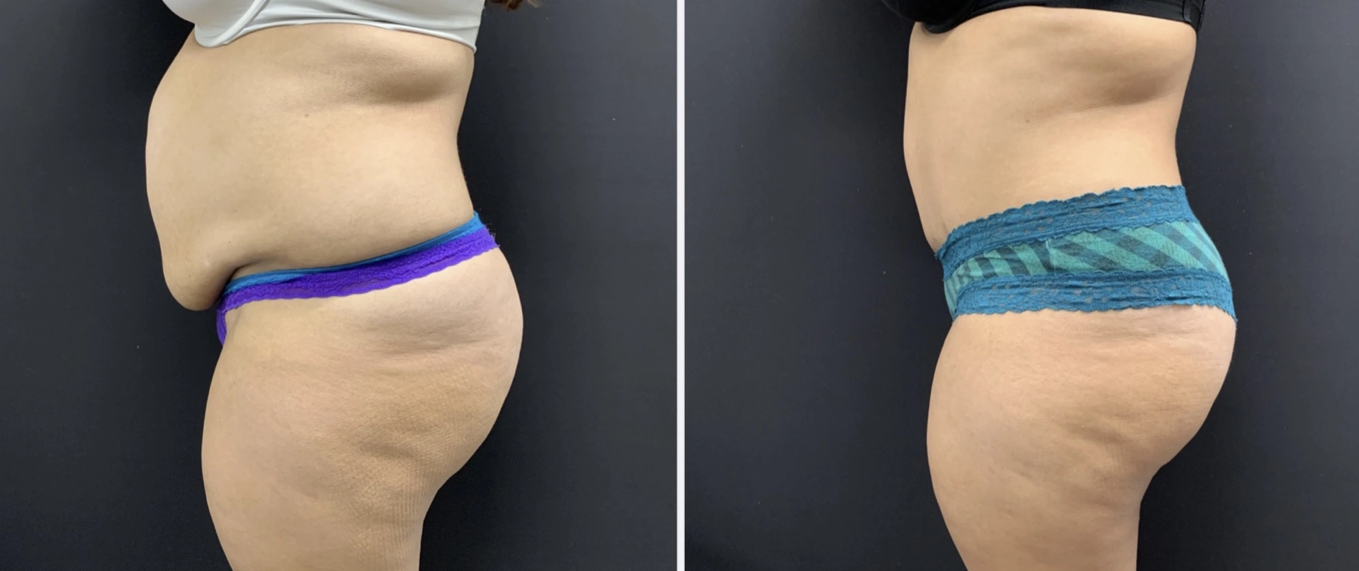 TUMMY TUCK Before & After Case Number 00064