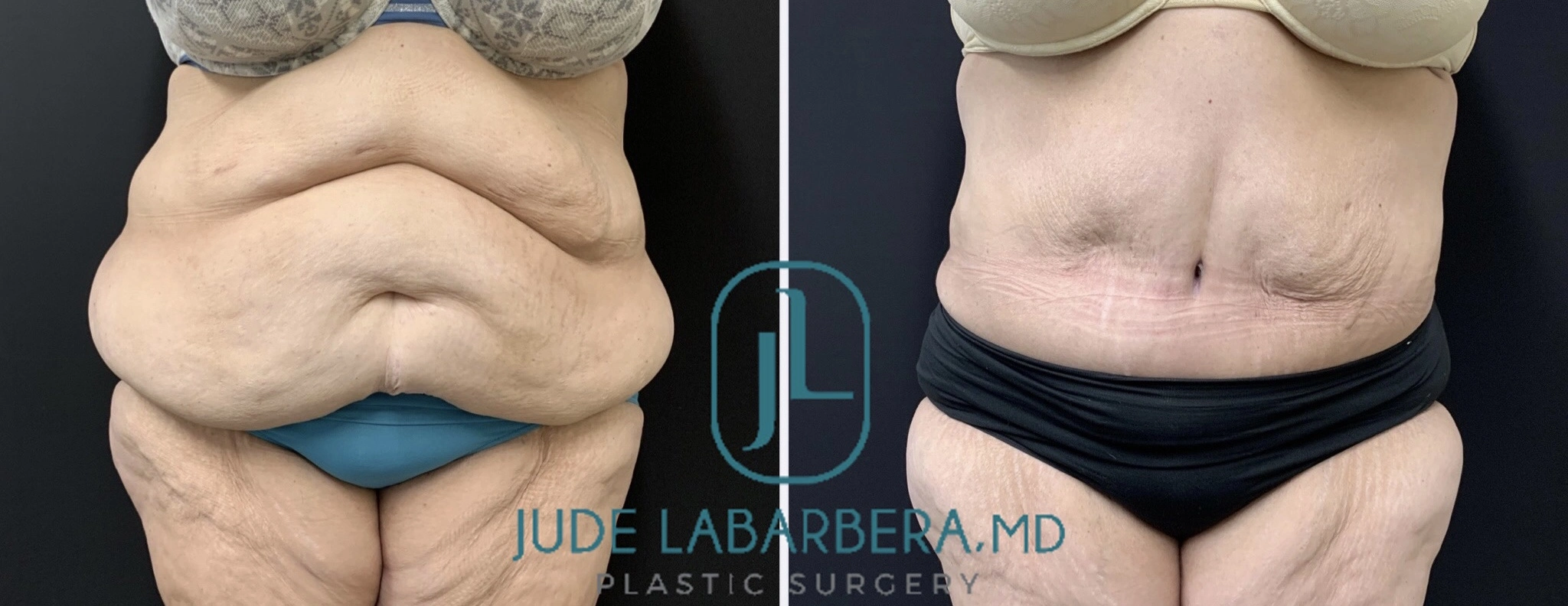 TUMMY TUCK Before & After Case Number 00065