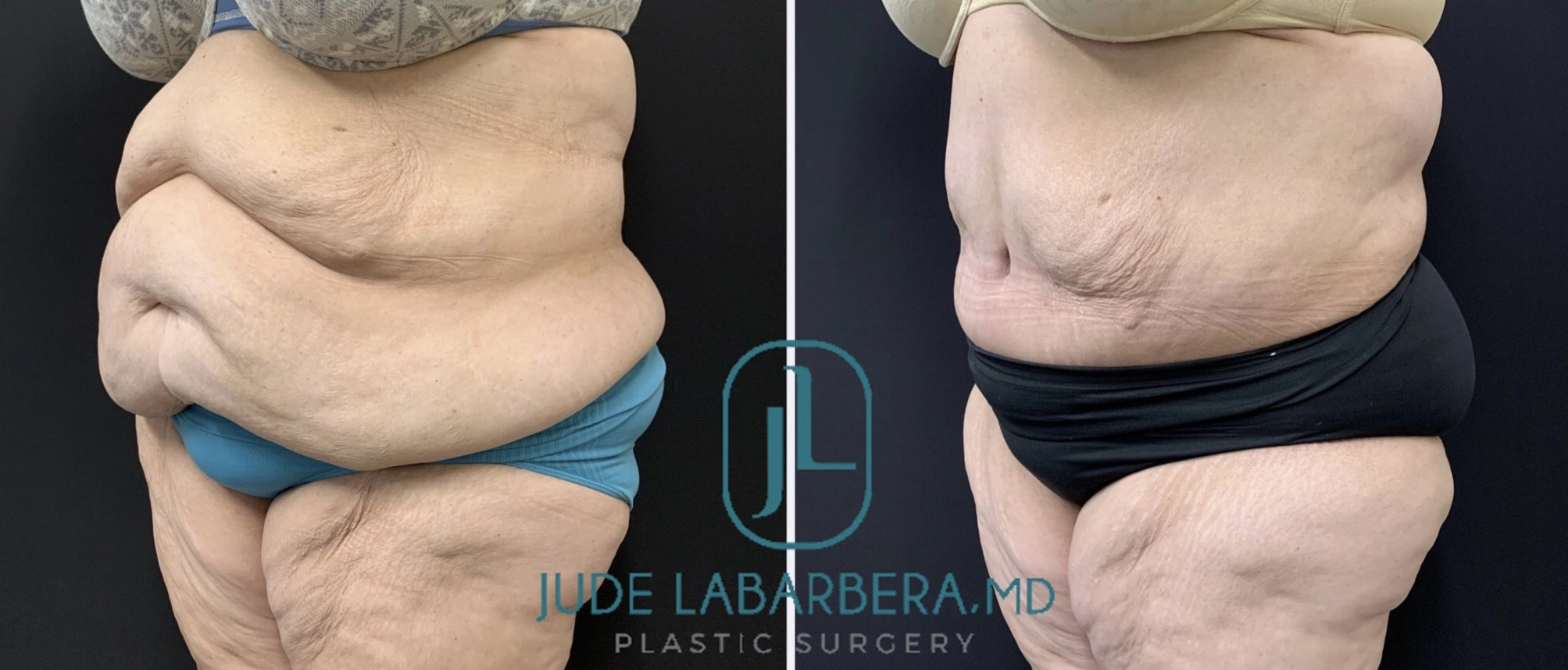 TUMMY TUCK Before & After Case Number 00065