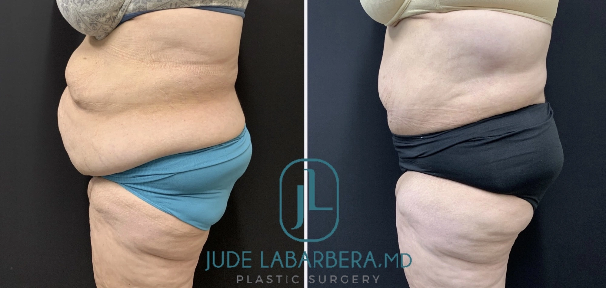 TUMMY TUCK Before & After Case Number 00065