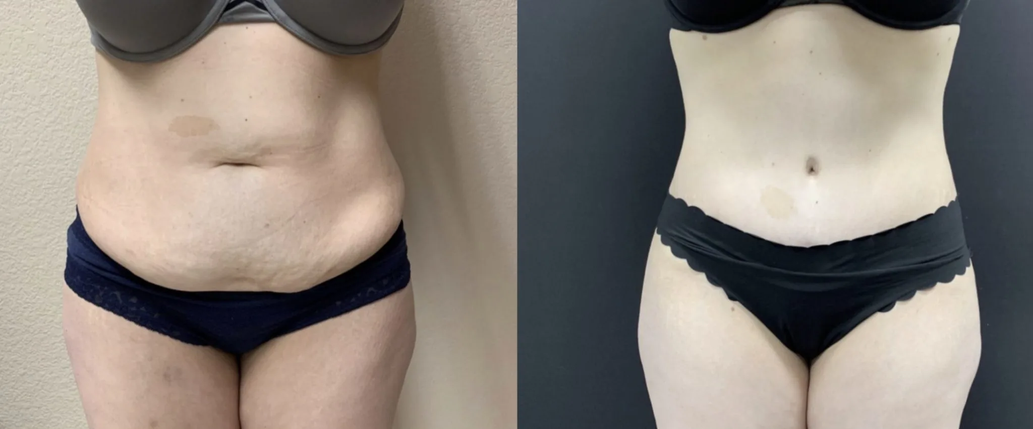 TUMMY TUCK Before & After Case Number 00067
