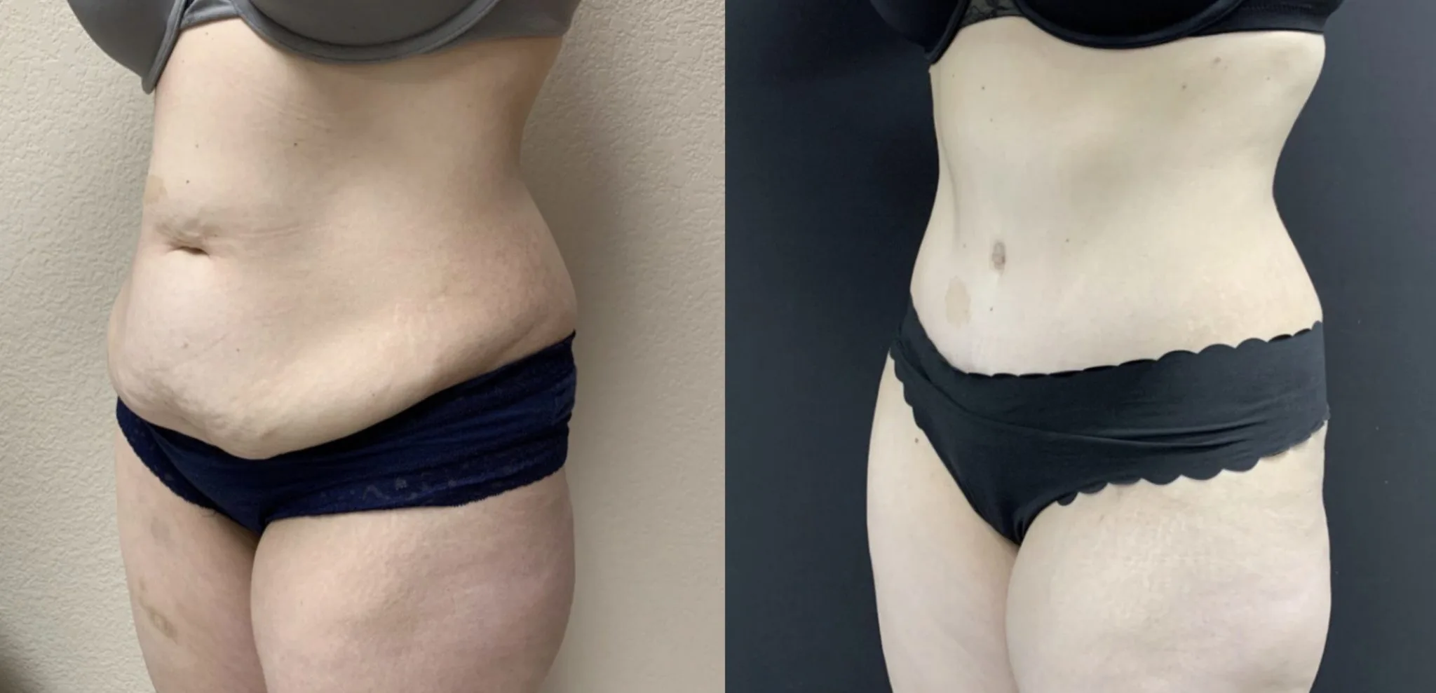 TUMMY TUCK Before & After Case Number 00067