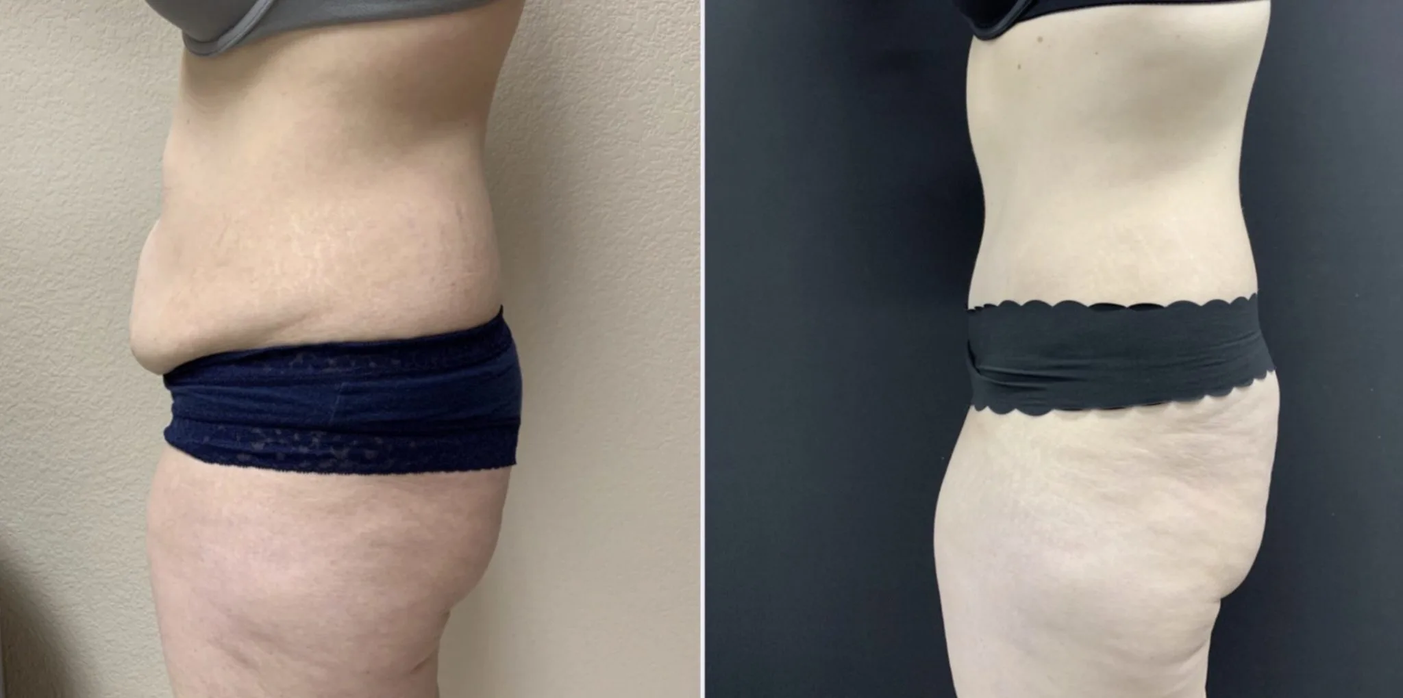 TUMMY TUCK Before & After Case Number 00067