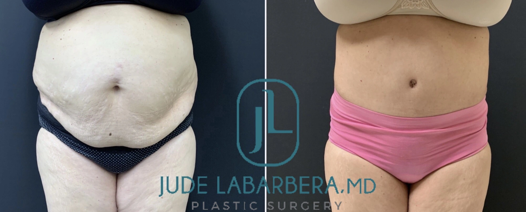 TUMMY TUCK Before & After Case Number 00069