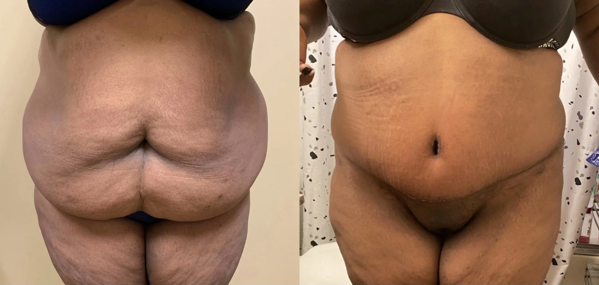 Tummy Tuck Before & After Case Number 0007