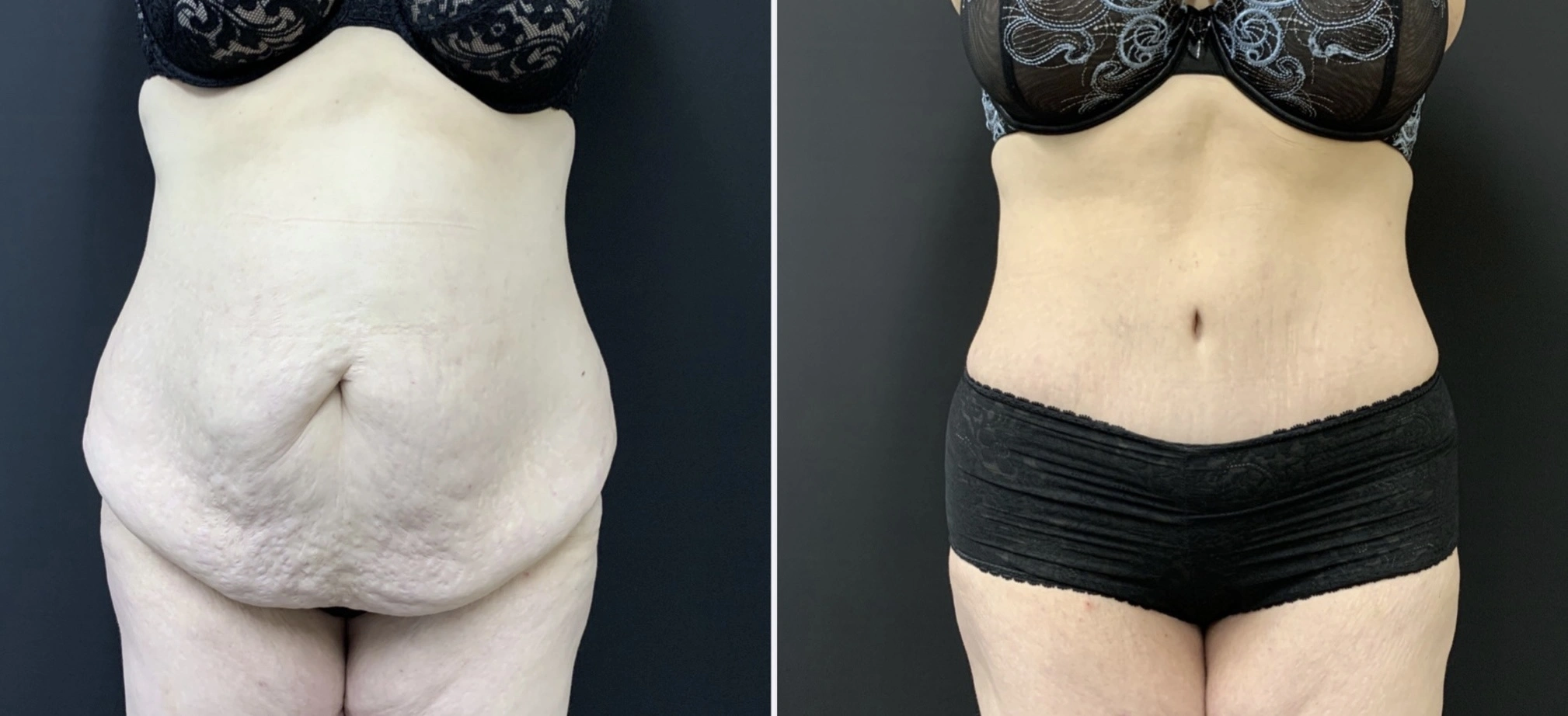 TUMMY TUCK Before & After Case Number 00070