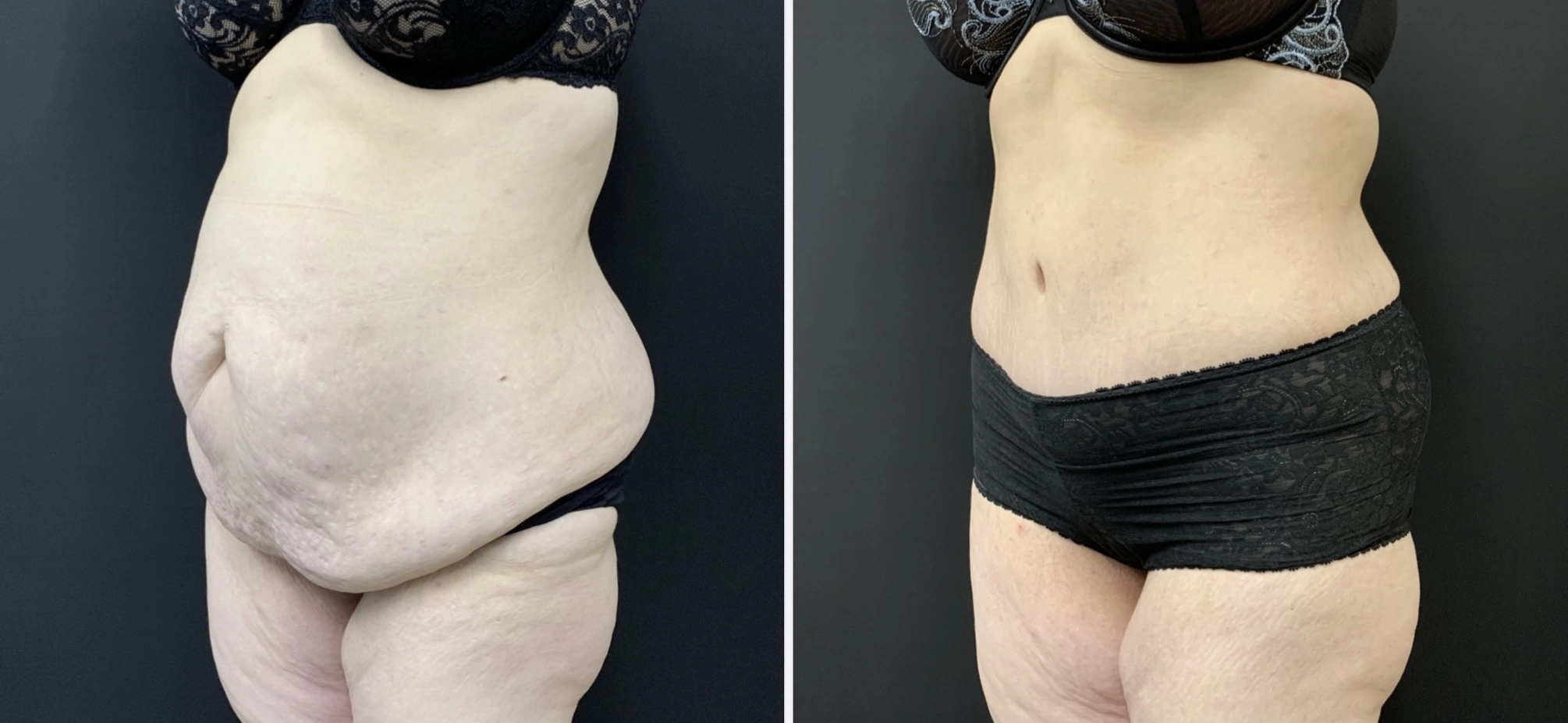 TUMMY TUCK Before & After Case Number 00070