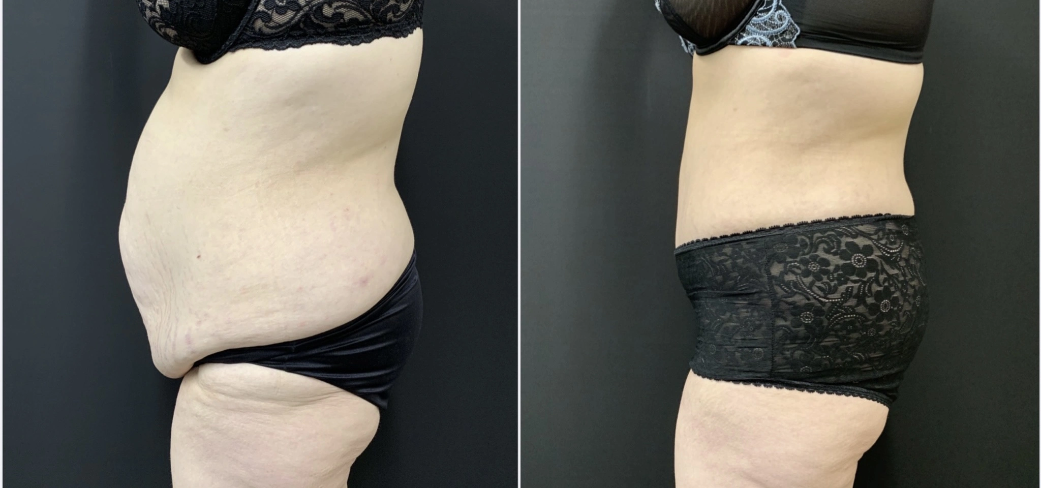 TUMMY TUCK Before & After Case Number 00070