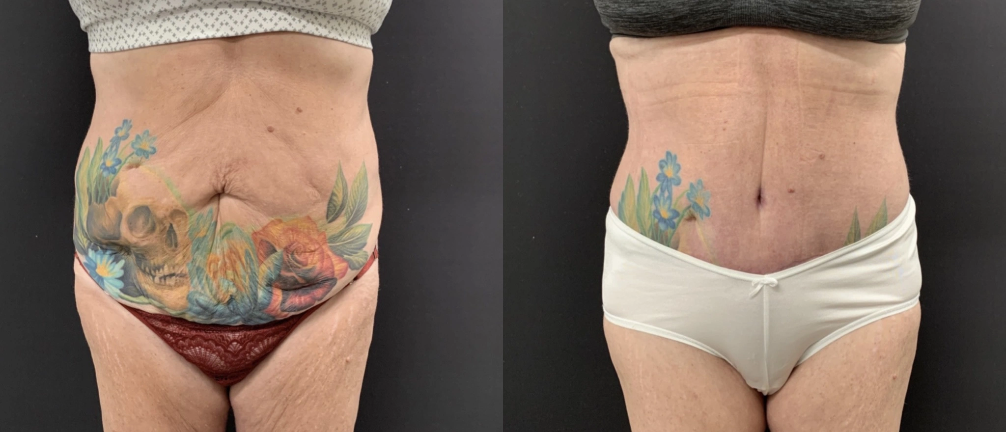 TUMMY TUCK Before & After Case Number 00071