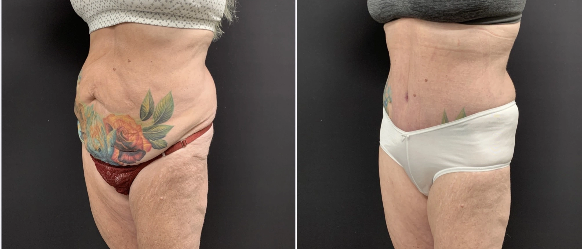 TUMMY TUCK Before & After Case Number 00071