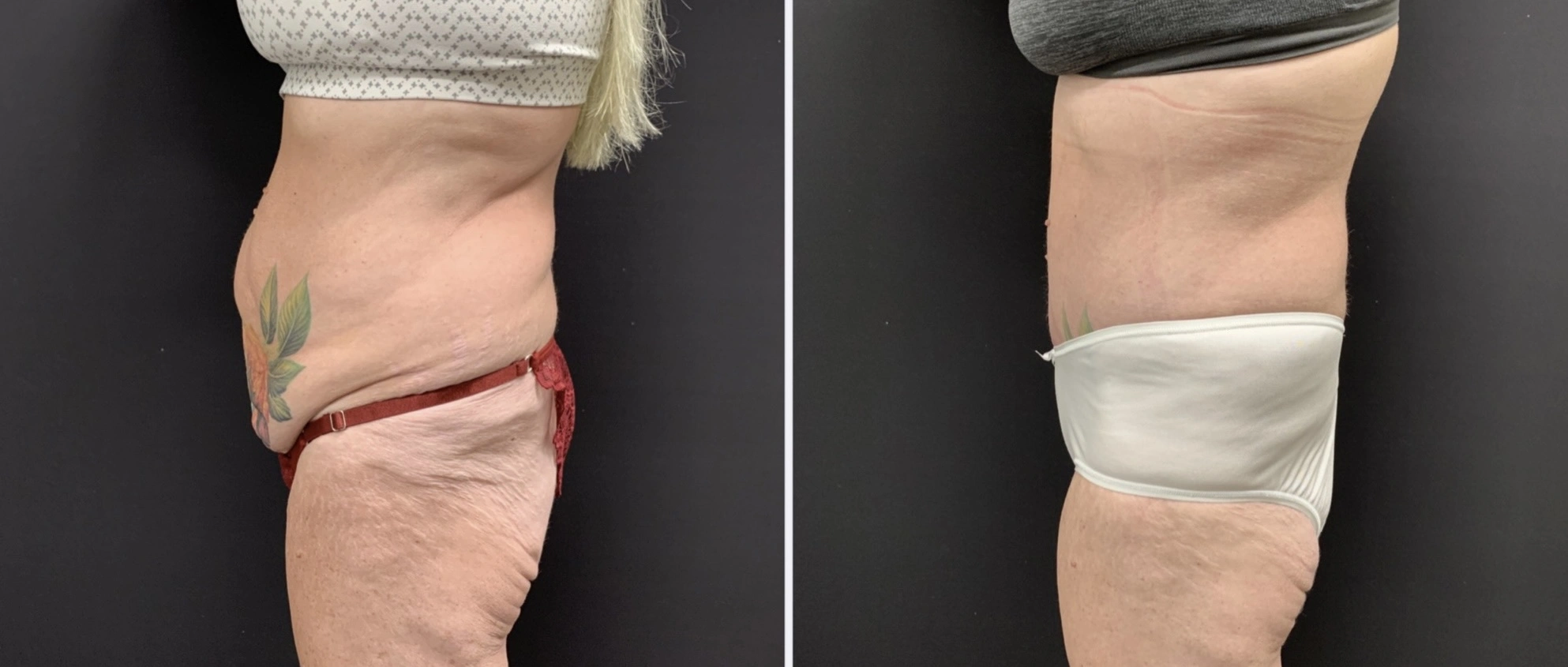 TUMMY TUCK Before & After Case Number 00071
