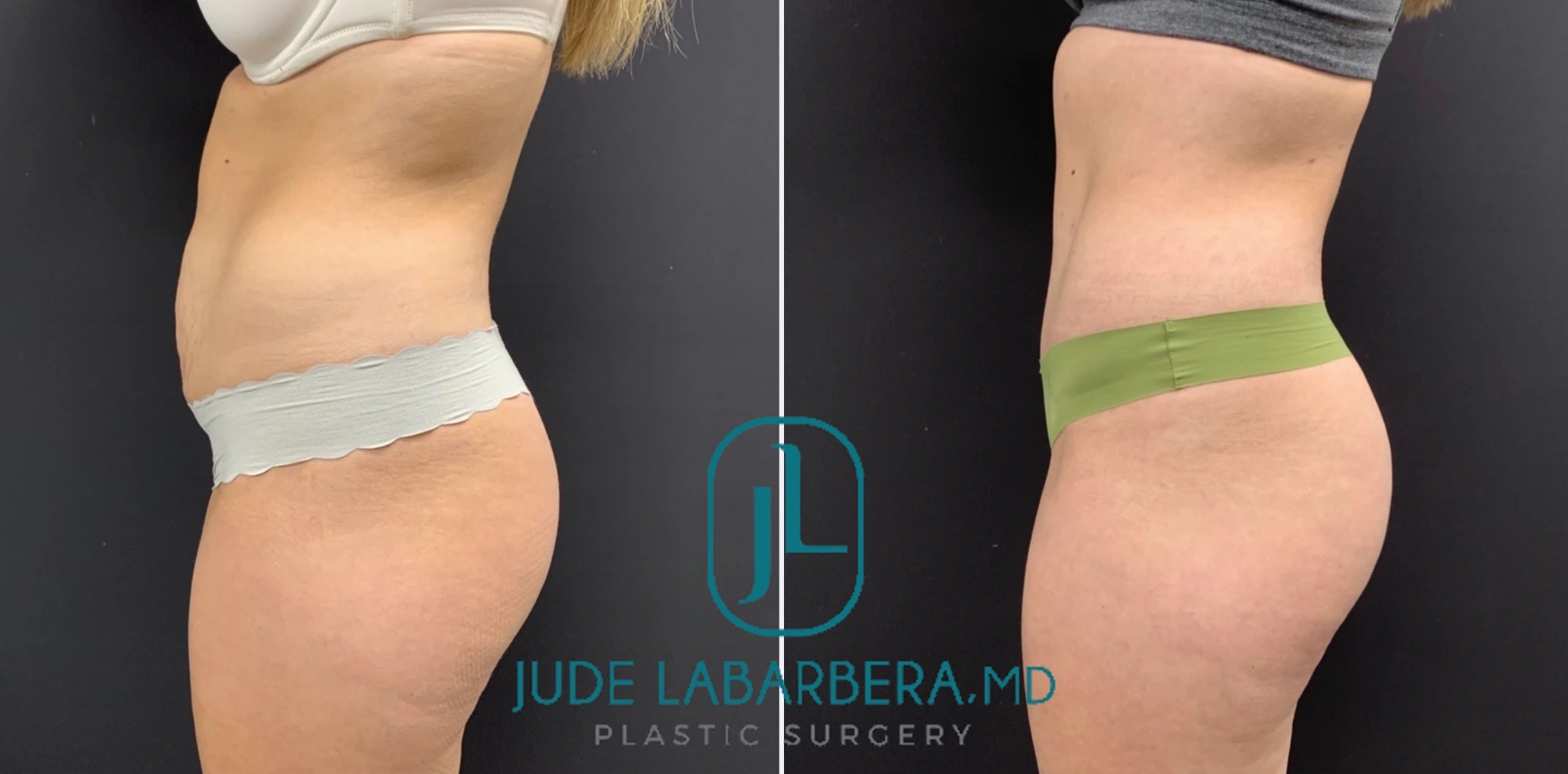 TUMMY TUCK Before & After Case Number 00073