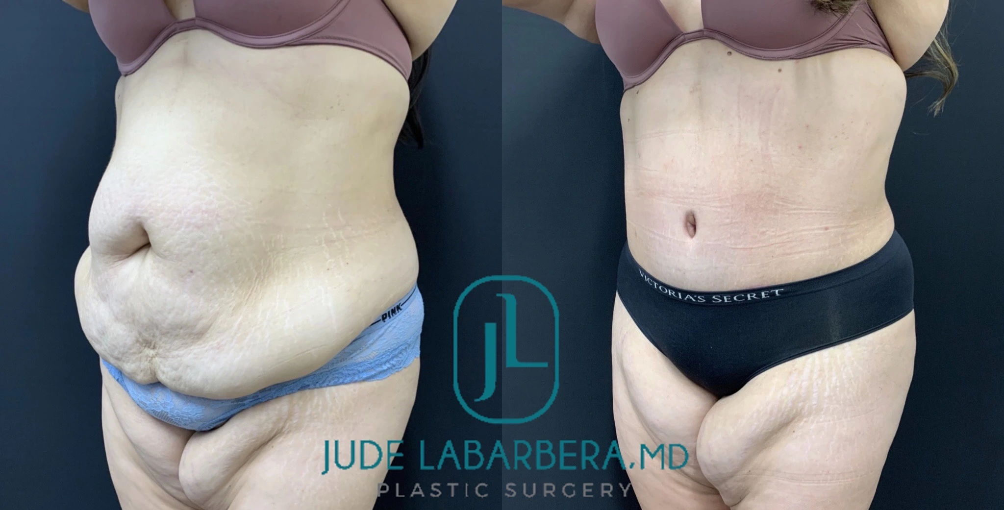 TUMMY TUCK Before & After Case Number 00074