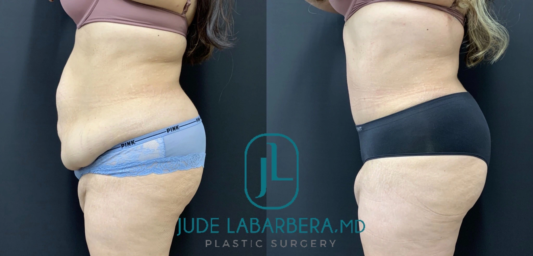 TUMMY TUCK Before & After Case Number 00074