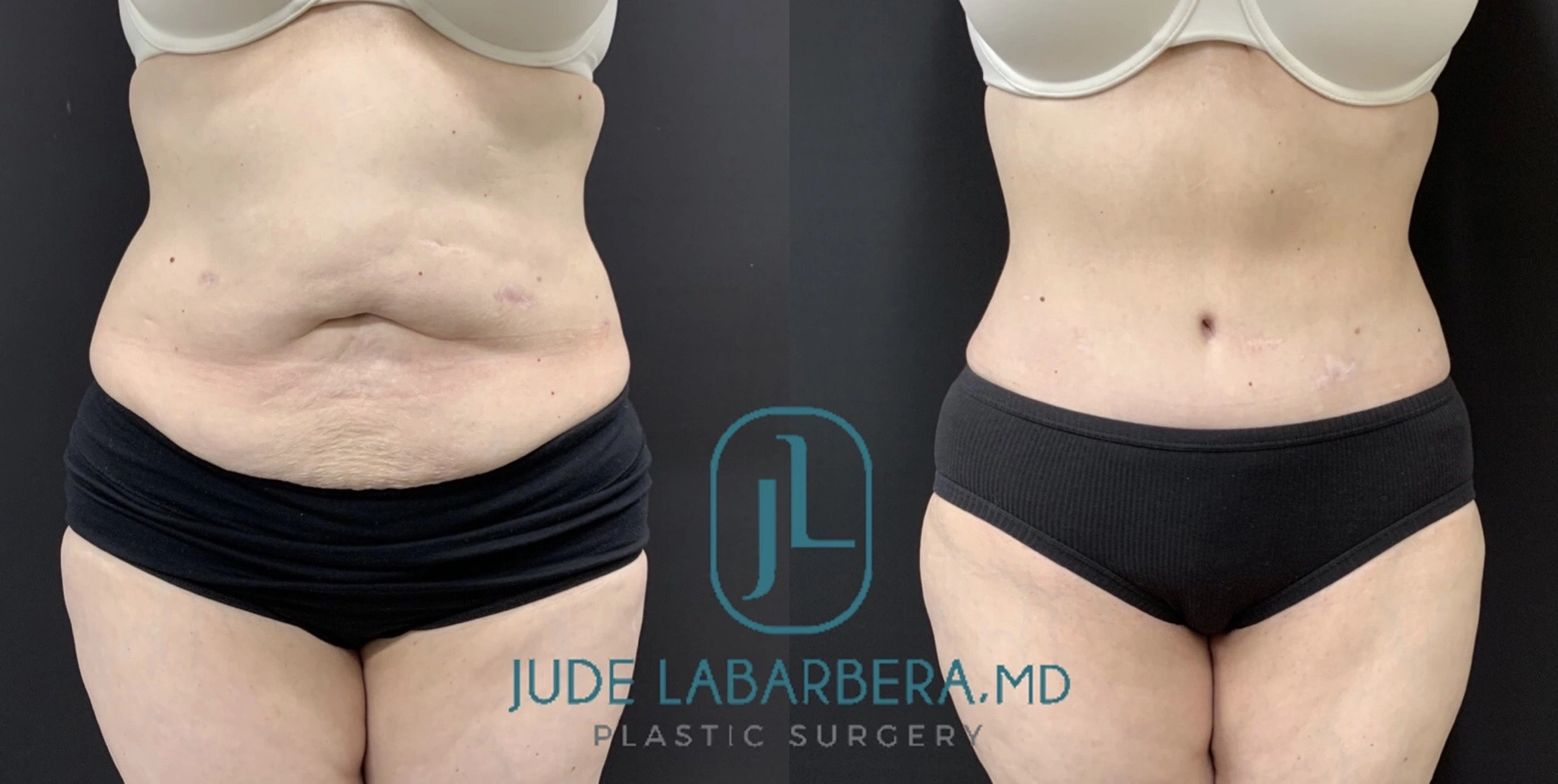 TUMMY TUCK Before & After Case Number 00076