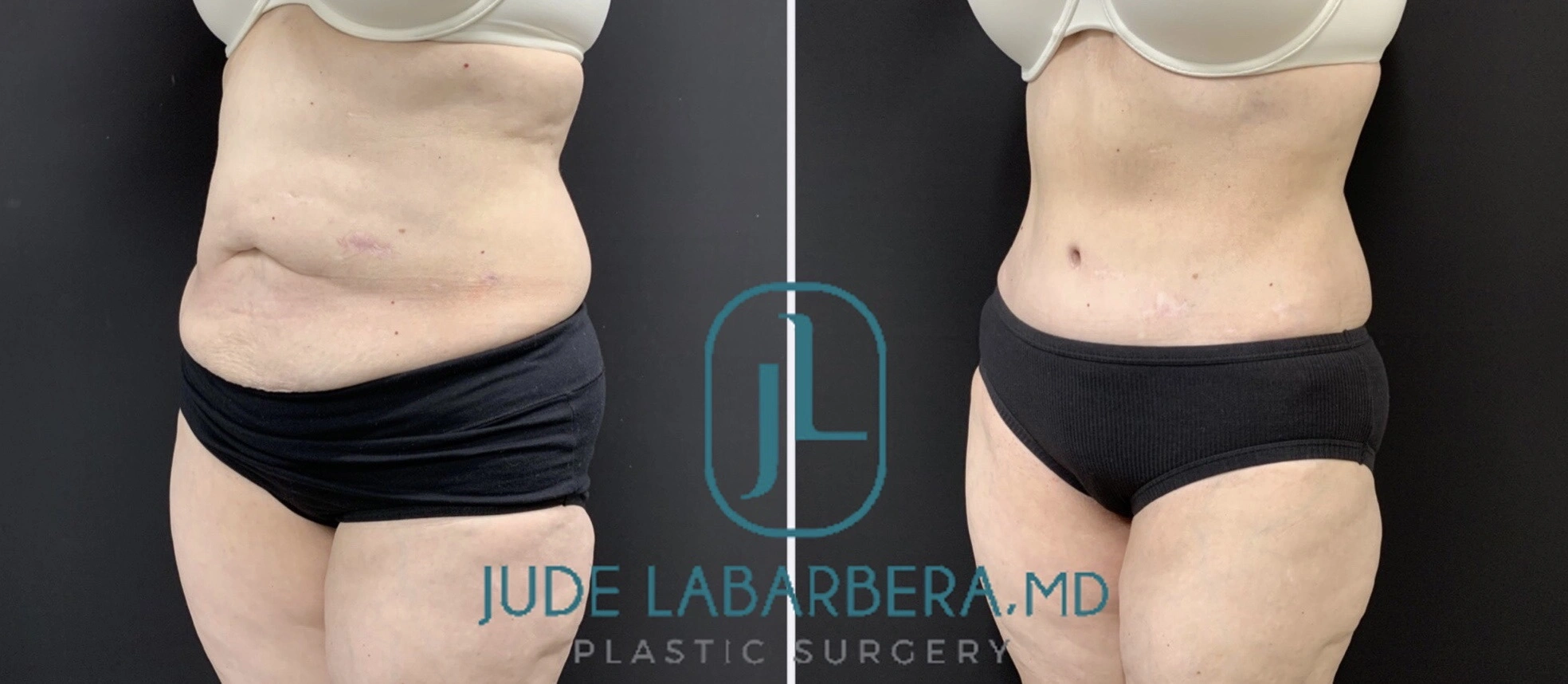 TUMMY TUCK Before & After Case Number 00076