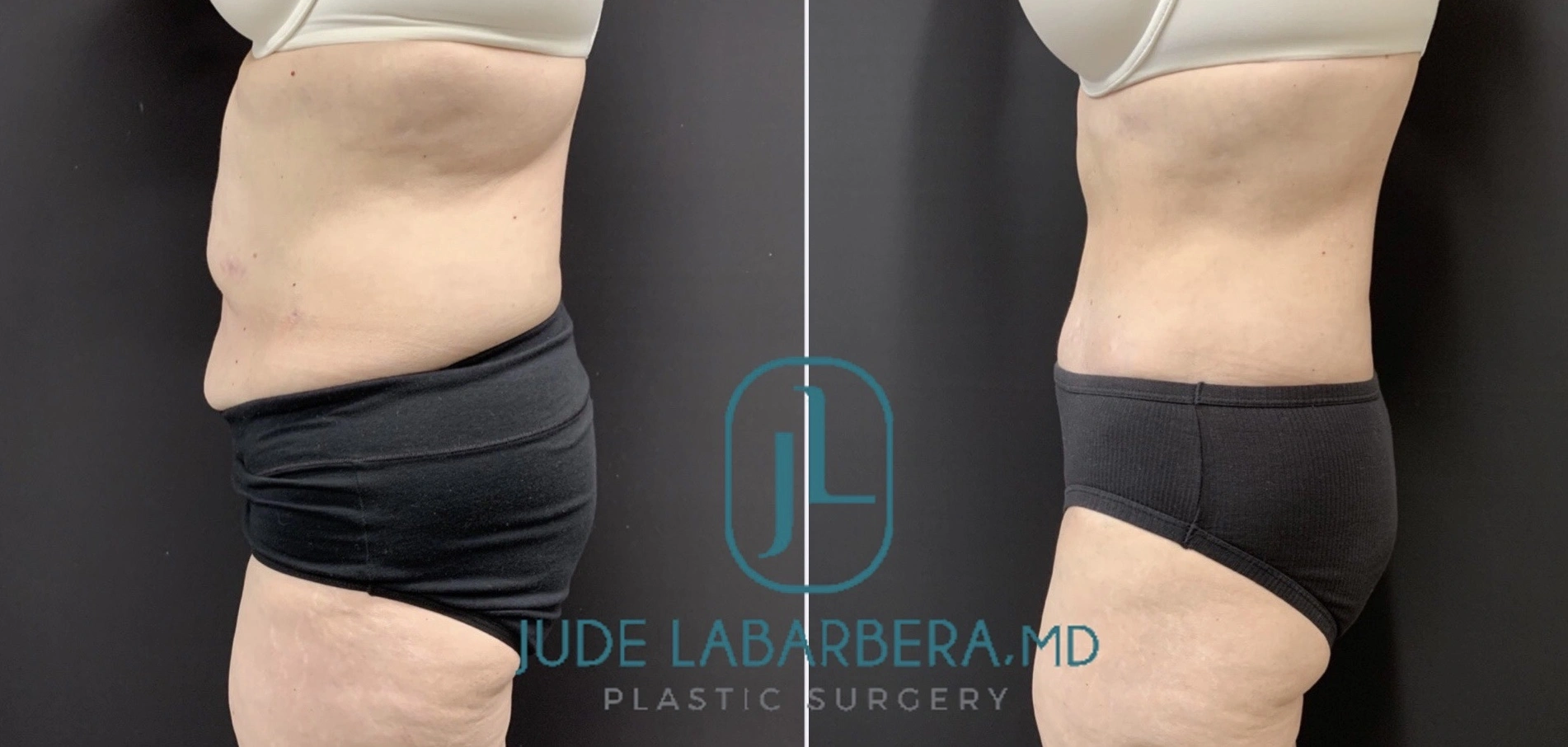 TUMMY TUCK Before & After Case Number 00076