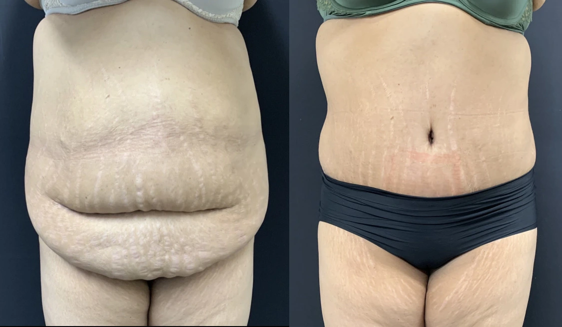 TUMMY TUCK Before & After Case Number 00078