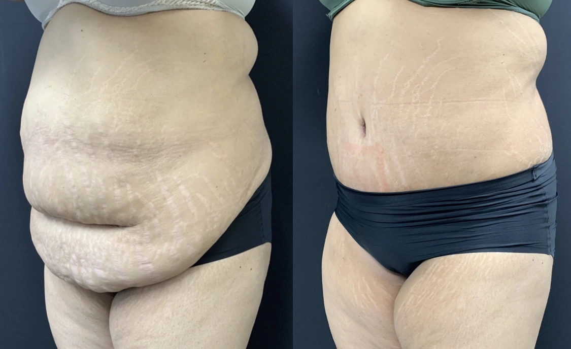 TUMMY TUCK Before & After Case Number 00078