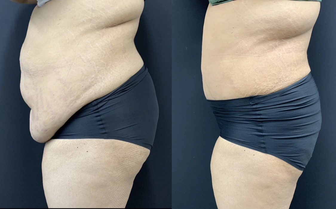 TUMMY TUCK Before & After Case Number 00078