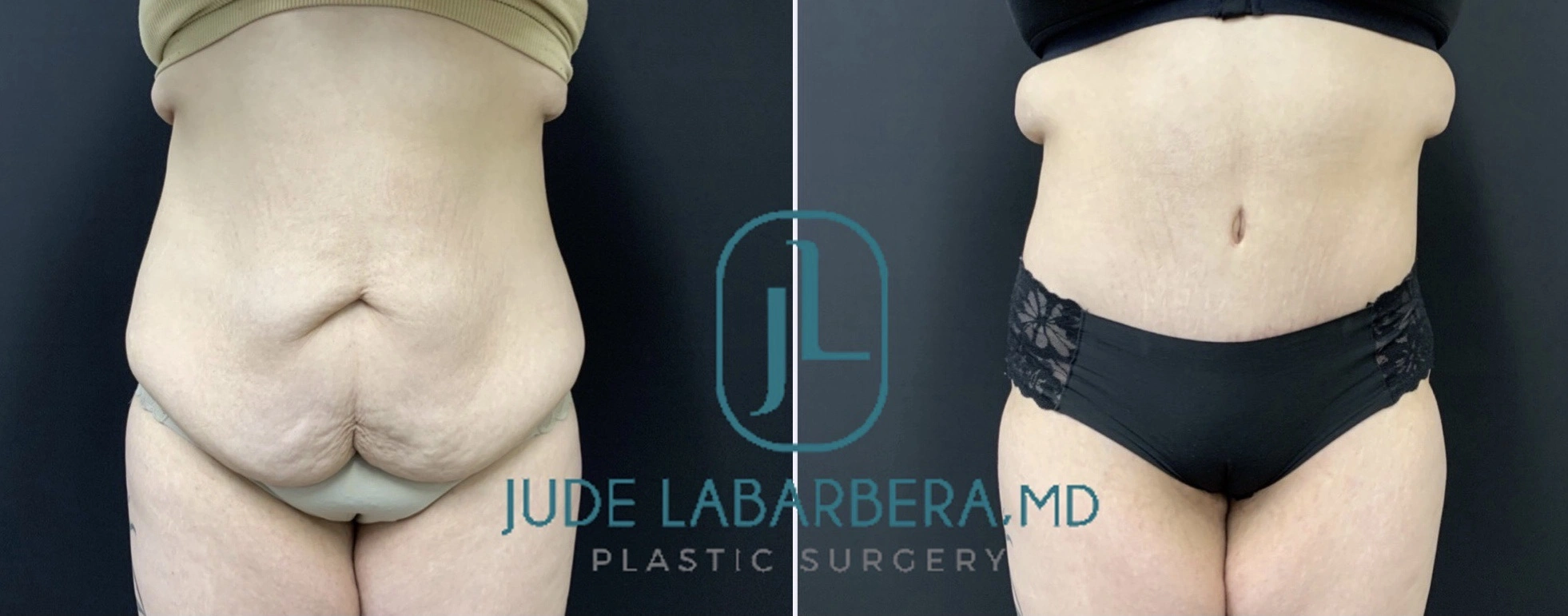 TUMMY TUCK Before & After Case Number 00085