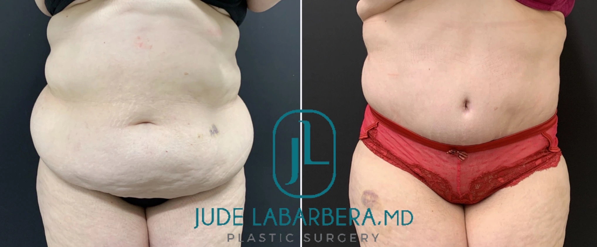 TUMMY TUCK Before & After Case Number 00089