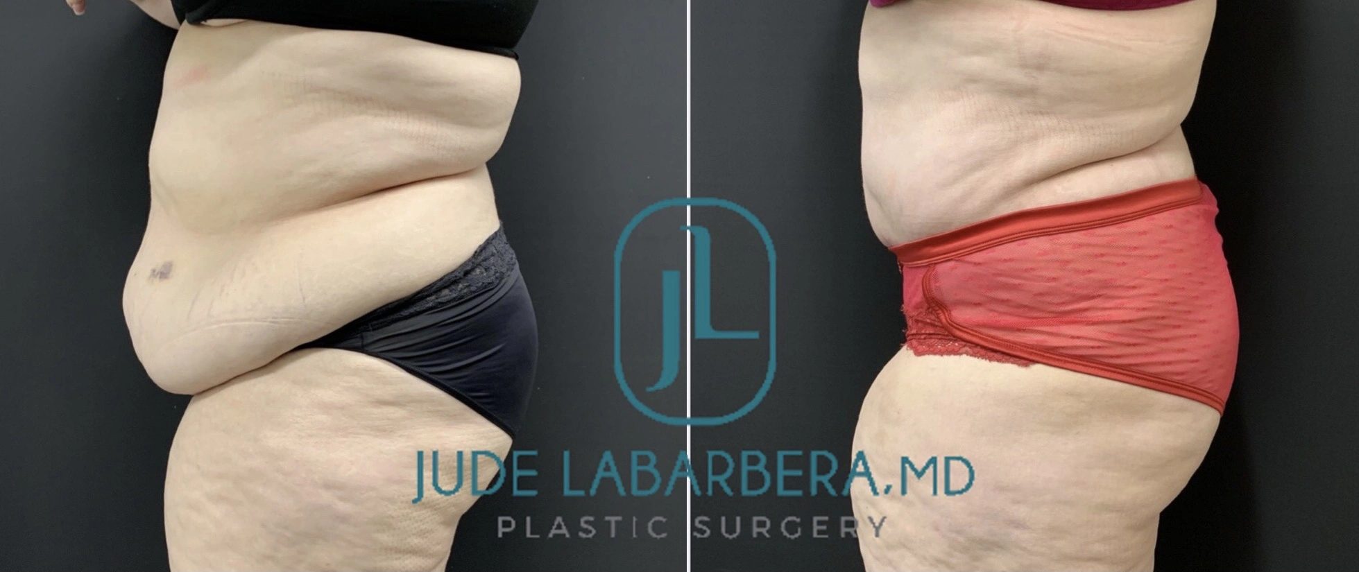 TUMMY TUCK Before & After Case Number 00089