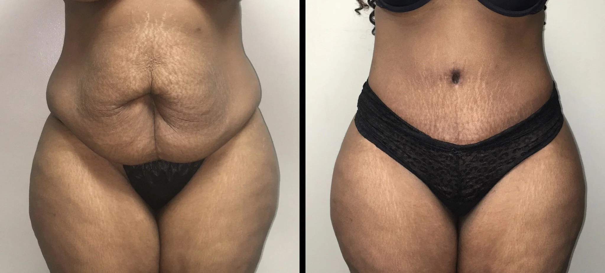 Tummy Tuck Before & After Case Number 0009