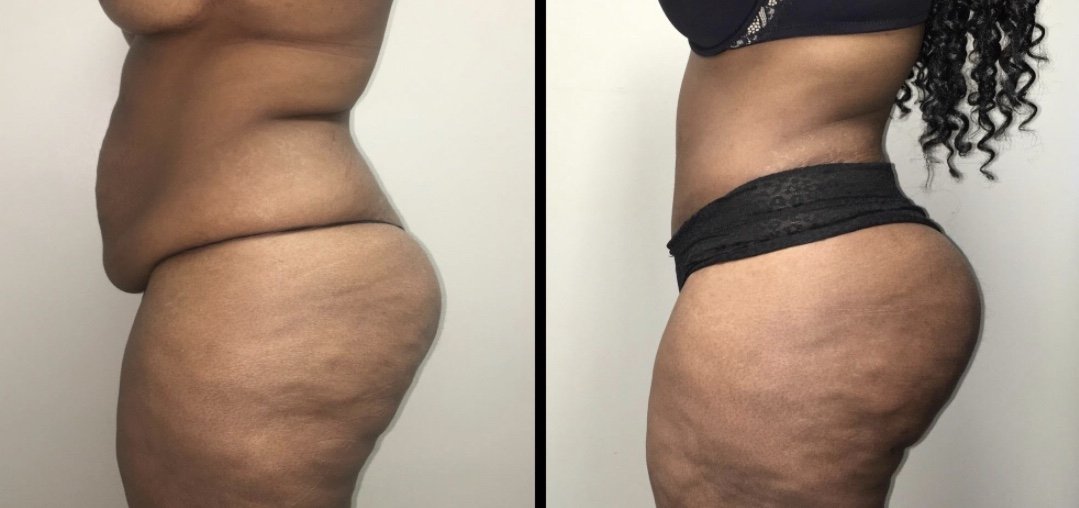 Tummy Tuck Before & After Case Number 0009