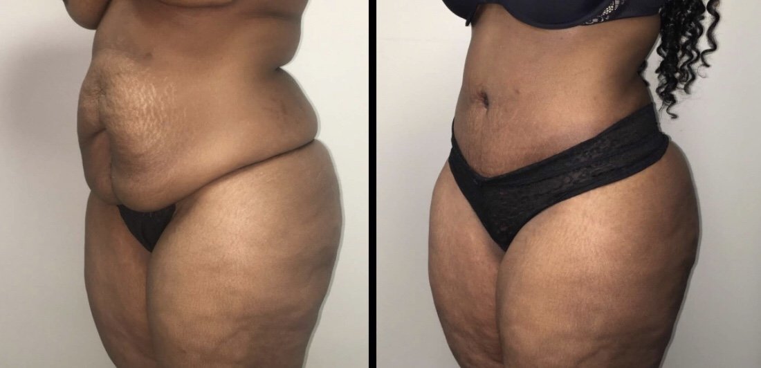 Tummy Tuck Before & After Case Number 0009