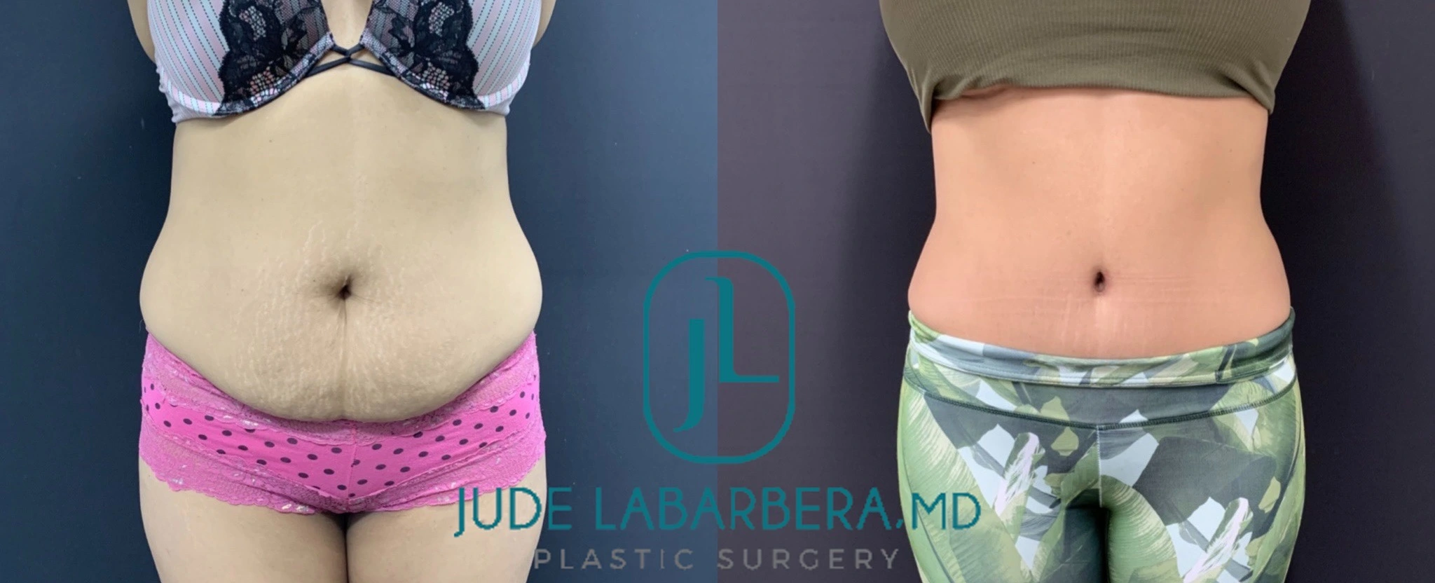 TUMMY TUCK Before & After Case Number 00091