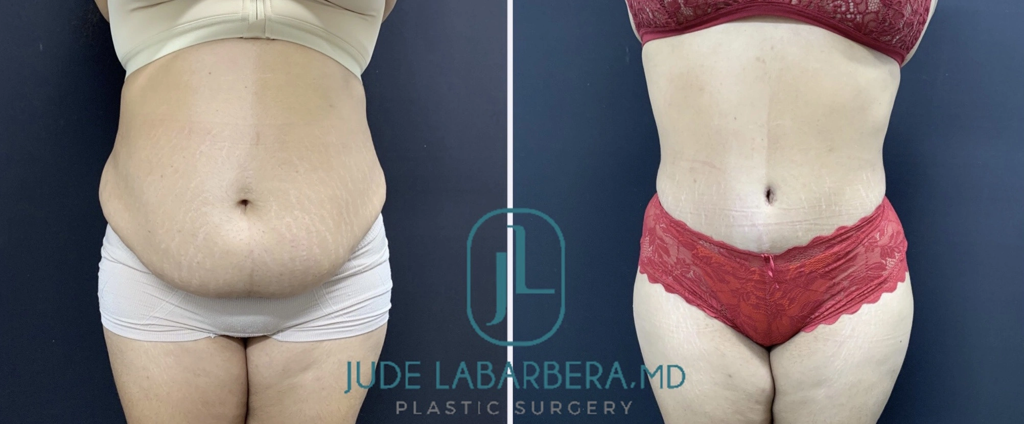 TUMMY TUCK Before & After Case Number 00092
