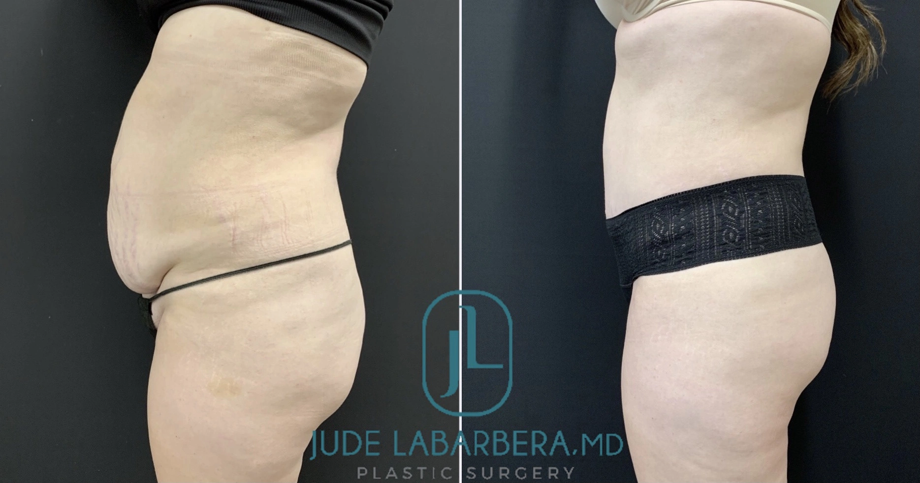 TUMMY TUCK Before & After Case Number 00093