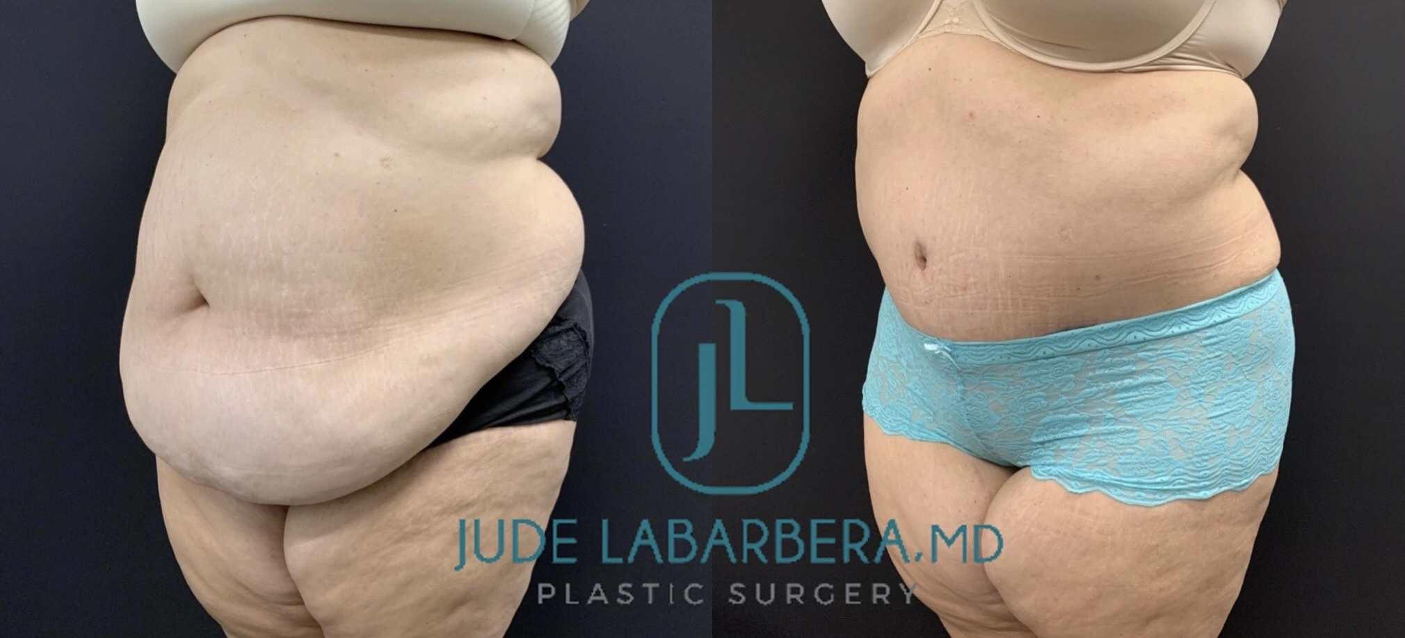 TUMMY TUCK Before & After Case Number 00094
