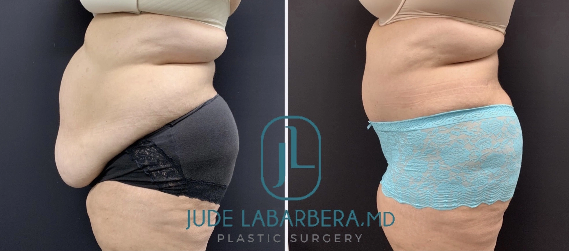 TUMMY TUCK Before & After Case Number 00094
