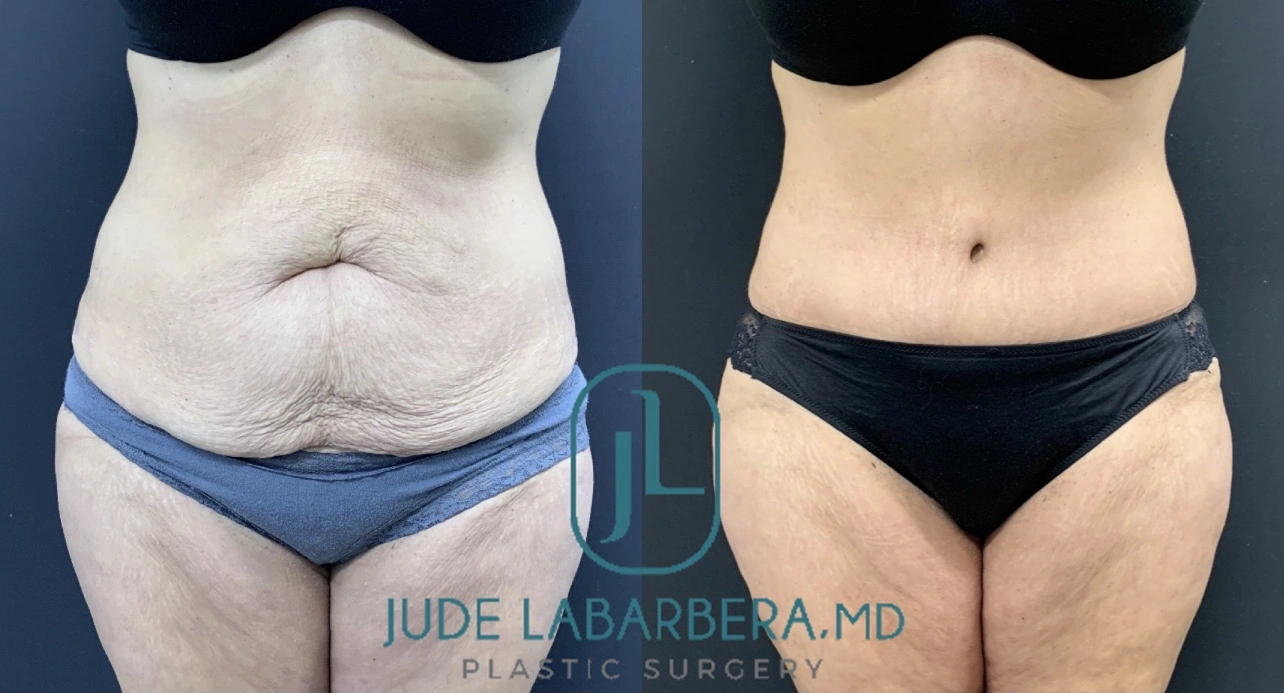 TUMMY TUCK Before & After Case Number 00095