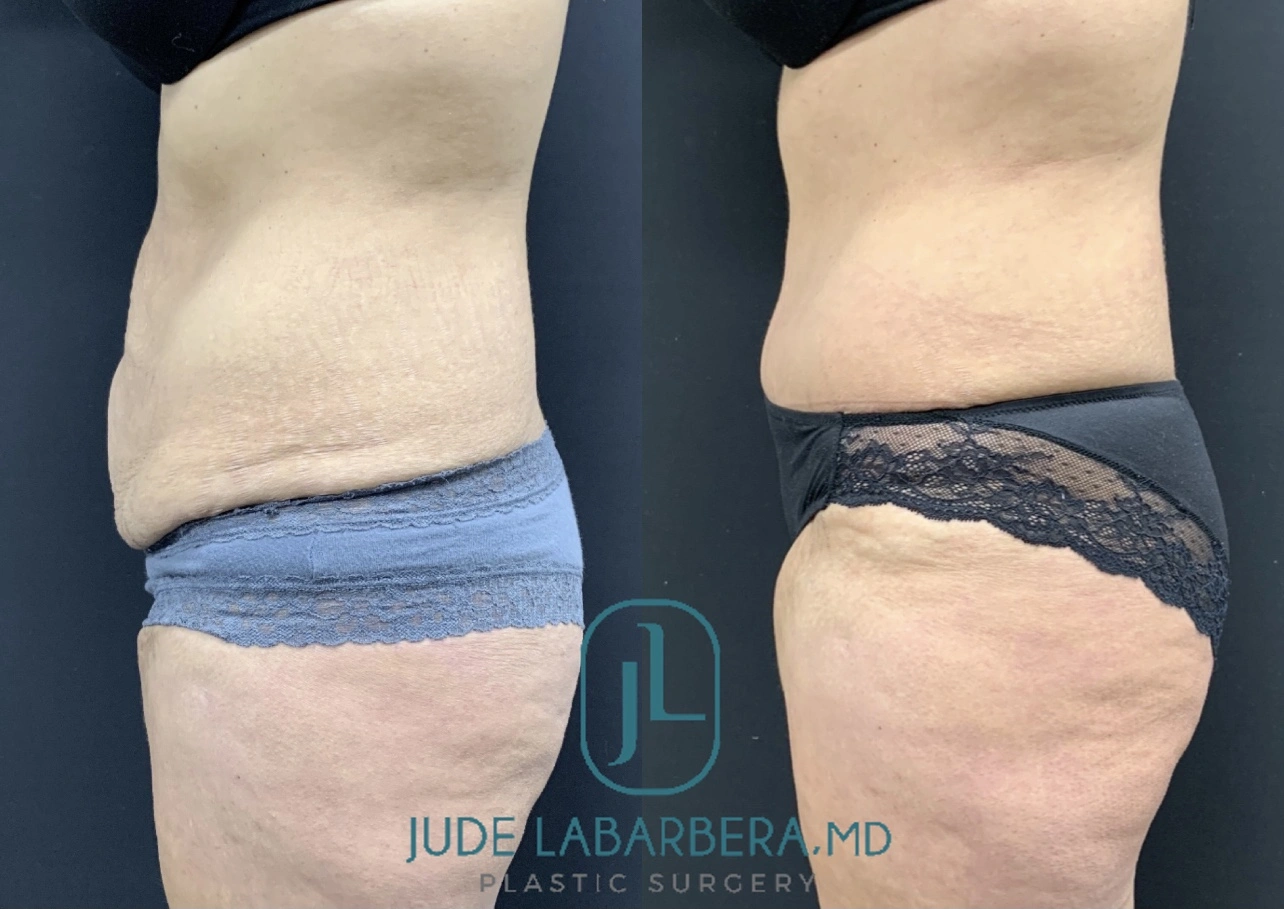 TUMMY TUCK Before & After Case Number 00095