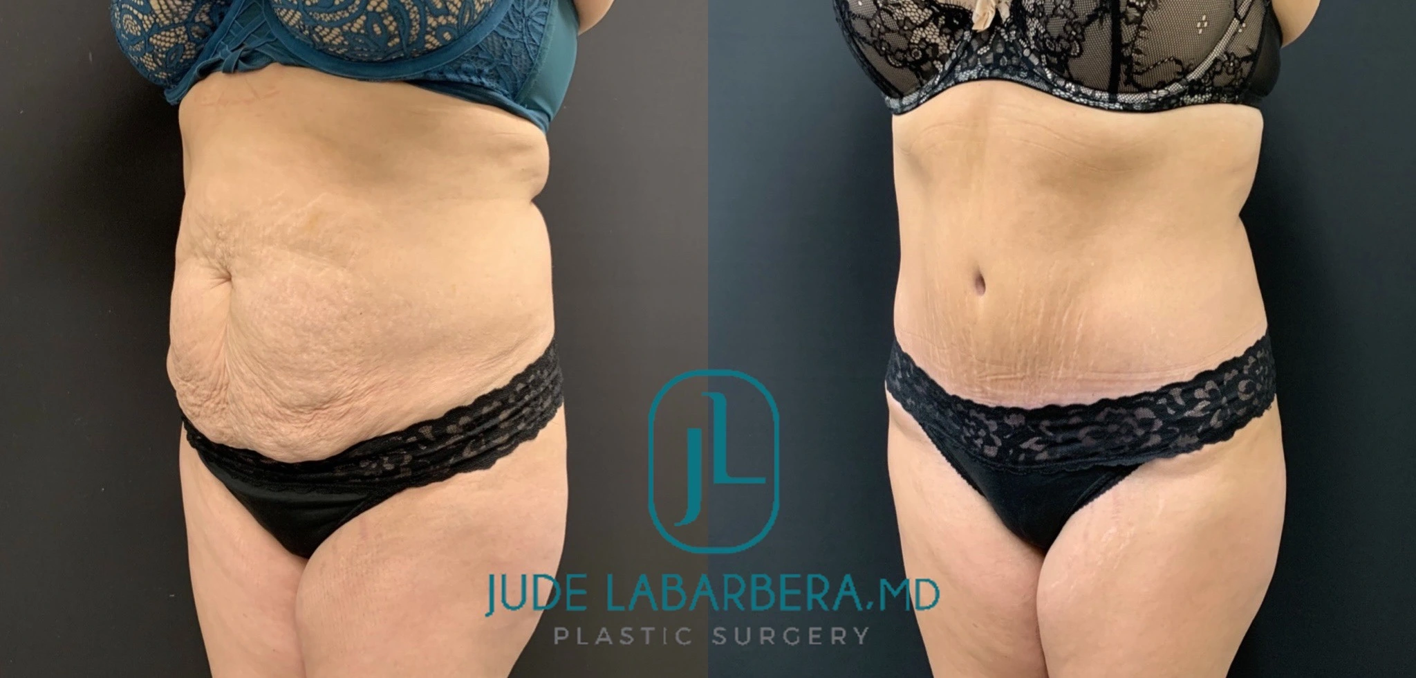 TUMMY TUCK Before & After Case Number 00096