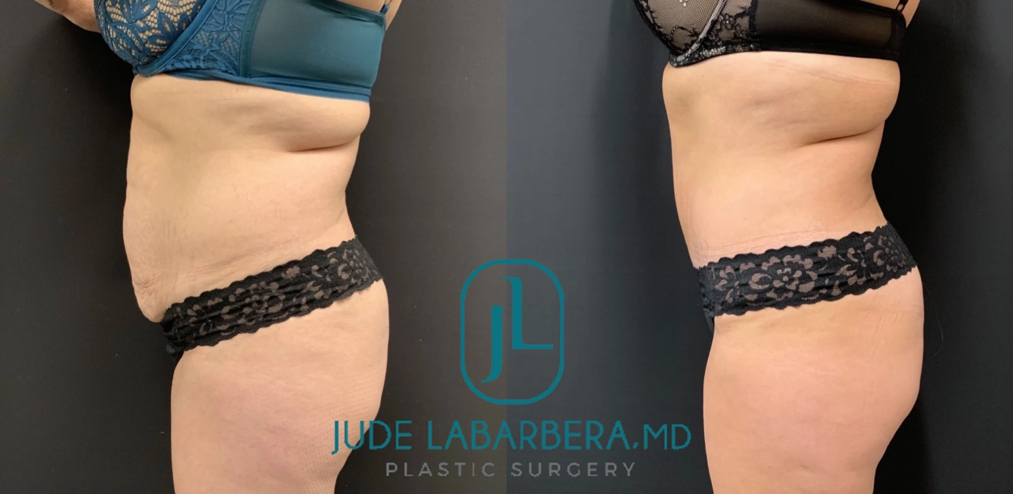 TUMMY TUCK Before & After Case Number 00096