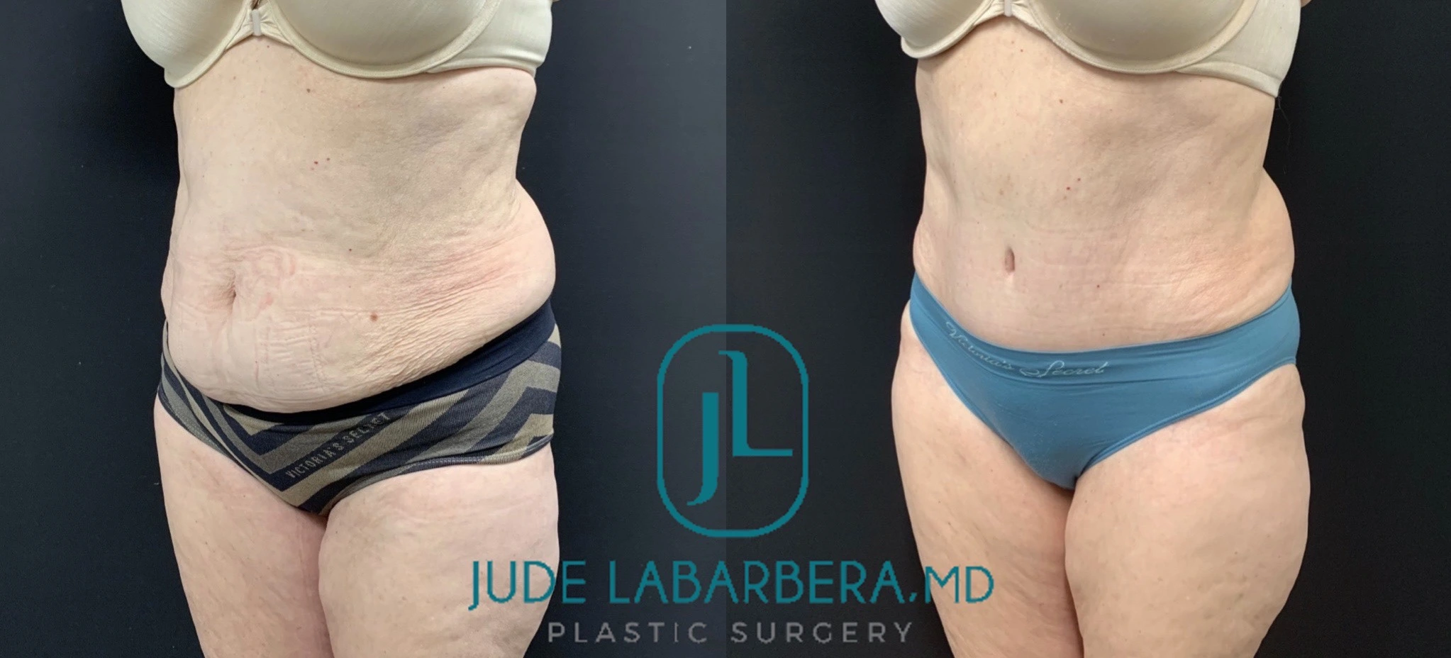 TUMMY TUCK Before & After Case Number 00097