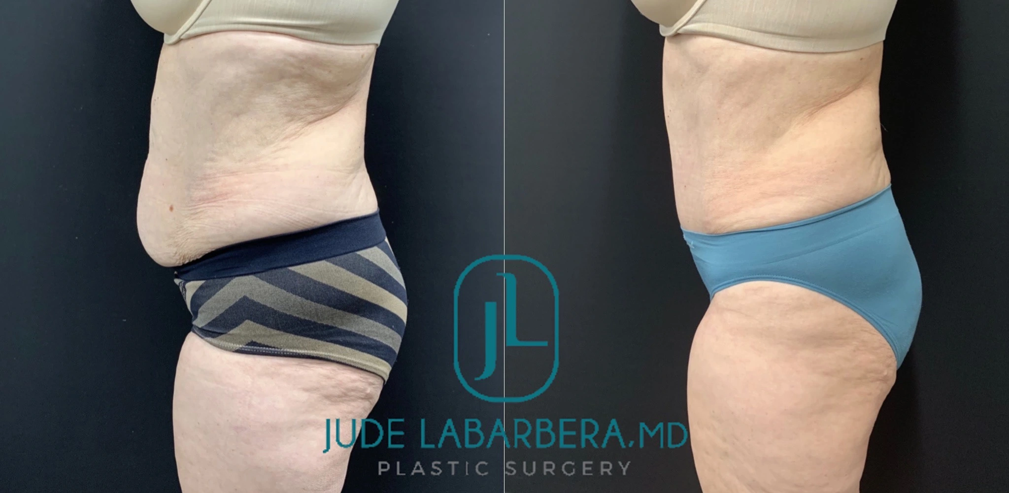 TUMMY TUCK Before & After Case Number 00097