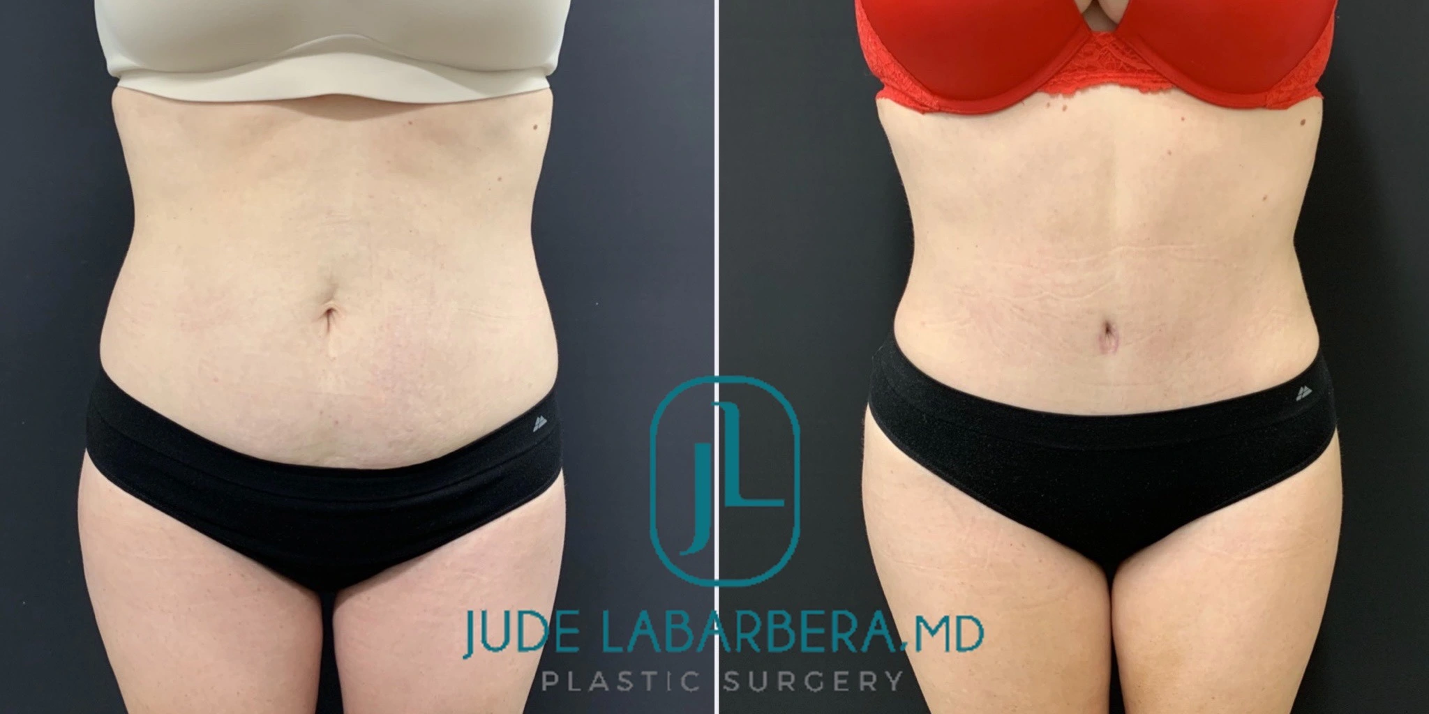 TUMMY TUCK WITH UMBILICAL HERNIA AND INGUINAL HERNIA REPAIR Before & After Case Number 00041