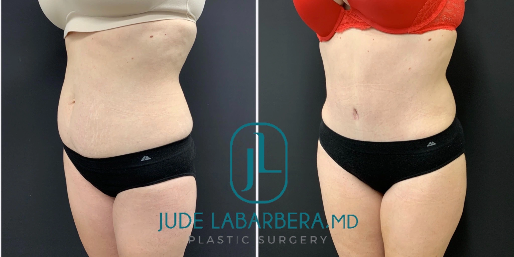 TUMMY TUCK WITH UMBILICAL HERNIA AND INGUINAL HERNIA REPAIR Before & After Case Number 00041