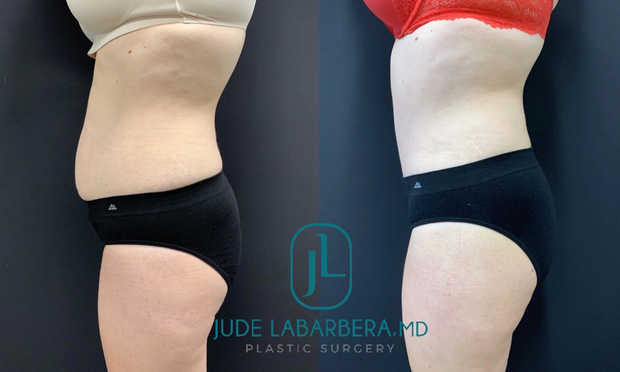 TUMMY TUCK WITH UMBILICAL HERNIA AND INGUINAL HERNIA REPAIR Before & After Case Number 00041