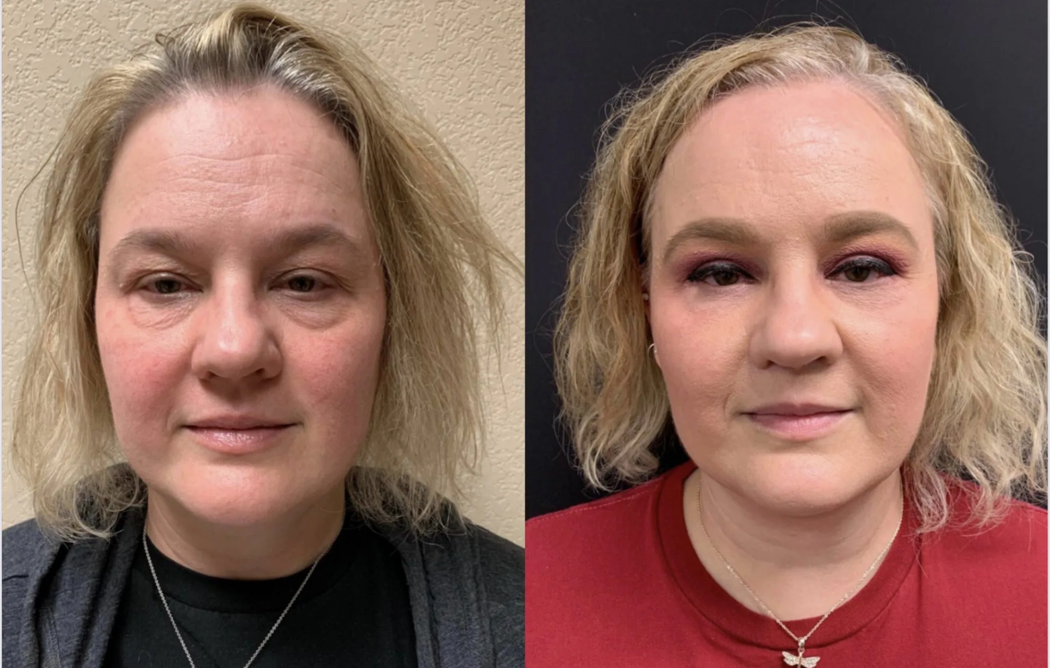 UPPER AND LOWER EYELID SURGERY Before & After Case Number 0005