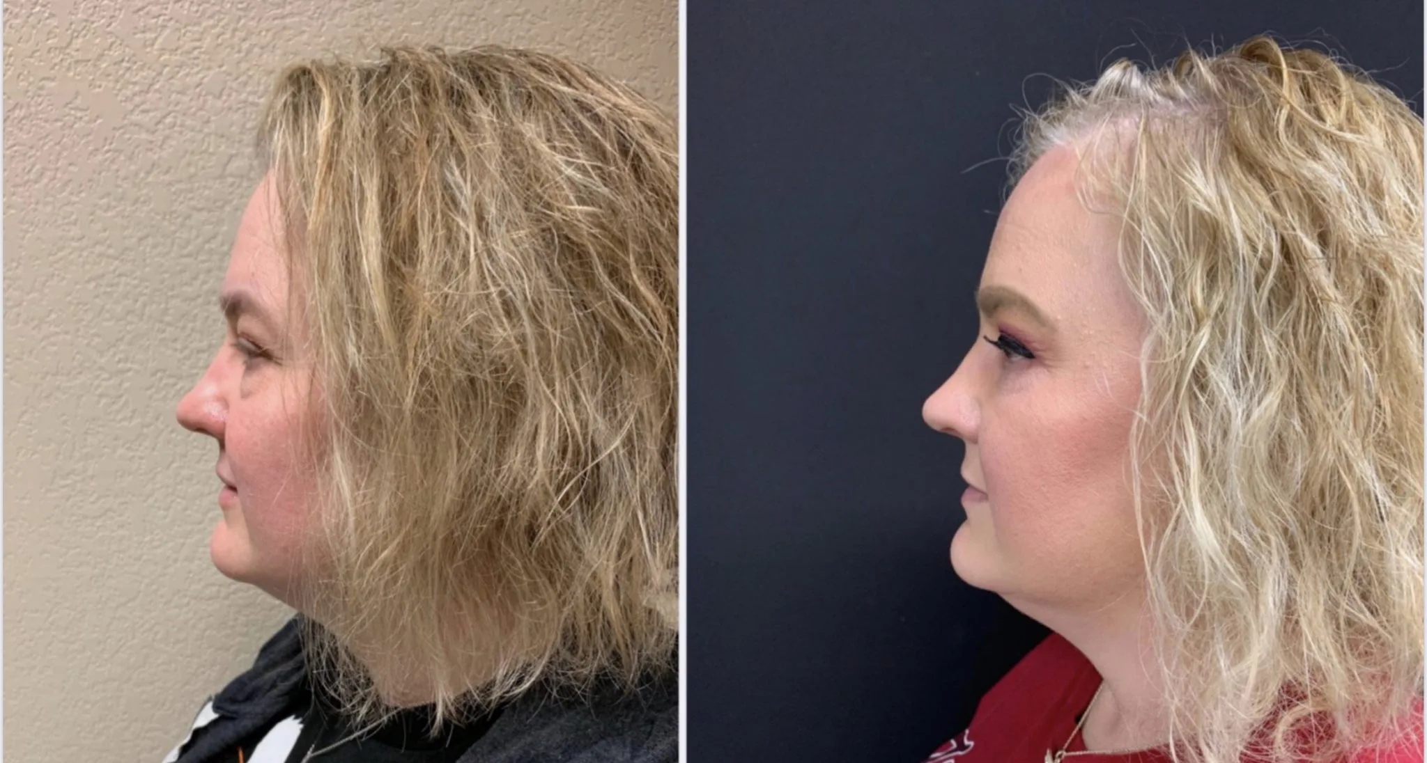 UPPER AND LOWER EYELID SURGERY Before & After Case Number 0005
